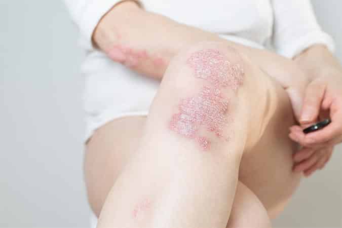 Is It Psoriasis or a Fungal Infection?